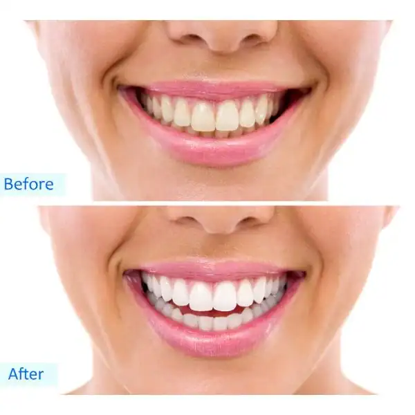 Woman's before and after results for Blue Light Teeth Whitening Eastleigh