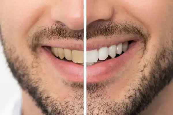 Before and after results for Blue Light Teeth Whitening Eastleigh