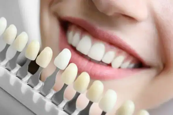 woman smiling before teeth whitening - to keep a smile safe Eastleigh