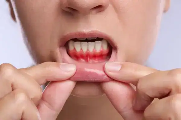 woman showing gum sensitivity before teeth whitening Eastleigh